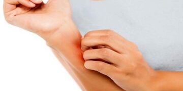 تغییرات پوستی نشانه کبد بیمار است