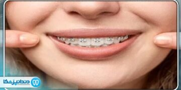 آیا کشیدن دندان برای درمان ارتودنسی لازم است؟
