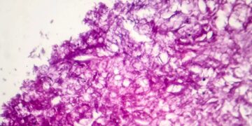 دانشمندان با تکنیک «مولکول‌های ارتعاشی» موفق به نابودی ۹۹ درصد از سلول‌های سرطانی شدند