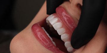 آیا کامپوزیت دندان باعث پوسیدگی می شود؟