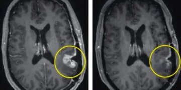 درمان جدید تومور مغزی را تنها در 5 روز ریشه