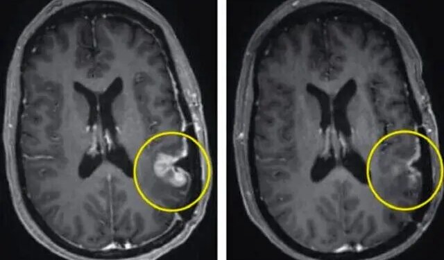 درمان جدید تومور مغزی را تنها در 5 روز ریشه