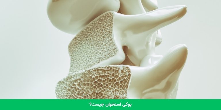 پوکی استخوان چیست؟ 