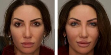 1719772262 عجیب و غریب؛ این جراحی رنگ چشم شما را تغییر