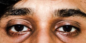 1720985452 کمبود چه ویتامینی دور چشم سیاه است؟