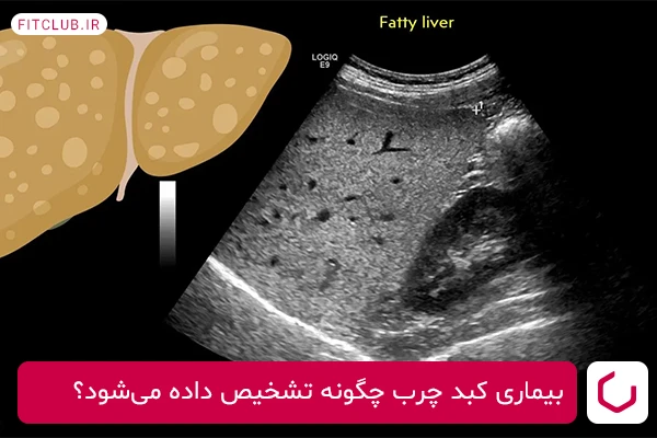 نحوه تشخیص بیماری کبد چرب خاموش