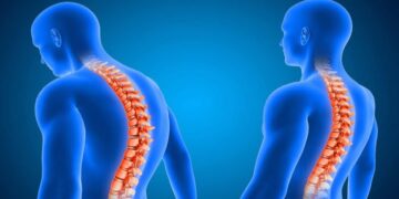 قوز کمر باعث بروز چه عوارضی می‌شود؟