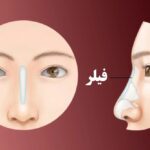 1740012679 285 پر کننده بینی ؛ آیا می توانم بدون جراحی بینی