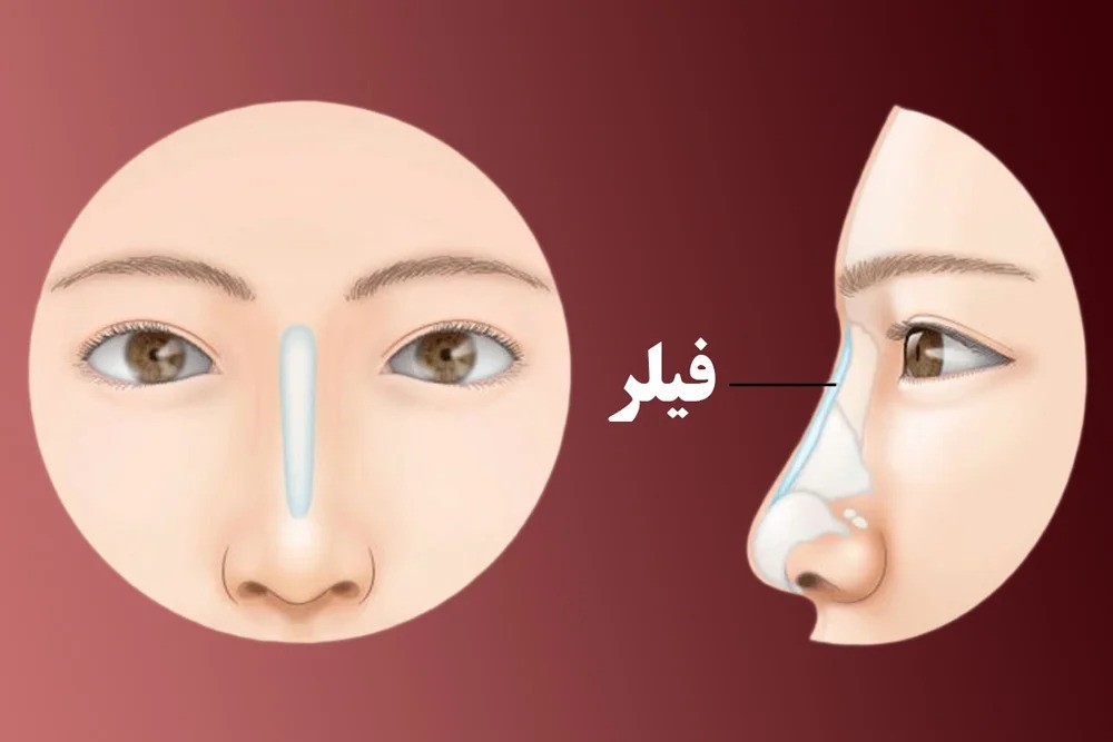 پر کننده بینی ؛ آیا می توانم بدون جراحی بینی ایده آل داشته باشم؟