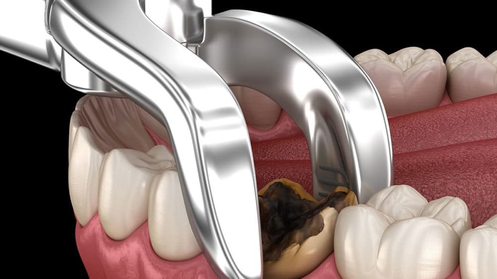 عوارض پس از استخراج دندان