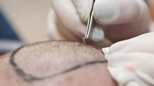 روش های کاشت مو