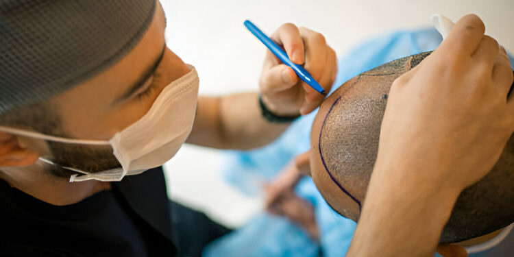 کاشت مو بدون بانک مو