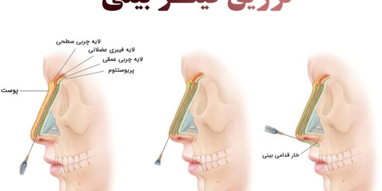 پر کننده بینی ؛ آیا می توانم بدون جراحی بینی