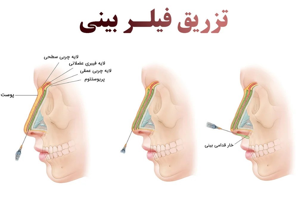 پر کننده بینی ؛ آیا می توانم بدون جراحی بینی ایده آل داشته باشم؟