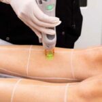 چرا بعد از لیزر ، پوست پیراشکی می شود! (20 علت + درمان ساده) 2 1741895555 170 چرا بعد از لیزر ، پوست پیراشکی می شود 20