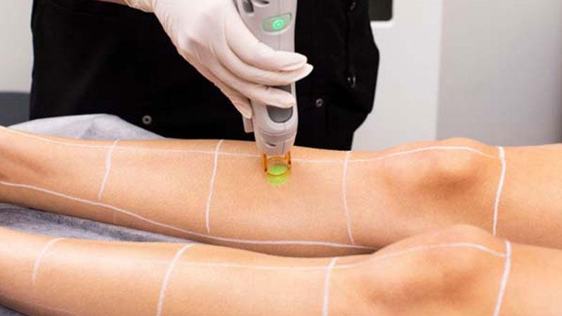 چرا بعد از لیزر ، پوست پیراشکی می شود! (20 علت + درمان ساده) 5 با استفاده از دستگاه های لیزر استاندارد