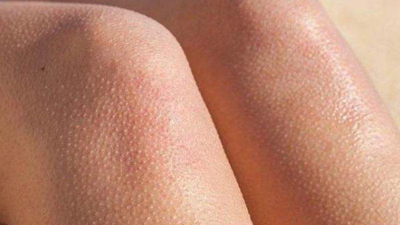 چرا بعد از لیزر ، پوست پیراشکی می شود! (20 علت + درمان ساده) 6 استفاده از ژل آلوئه ورا برای بهبود التهاب پوست