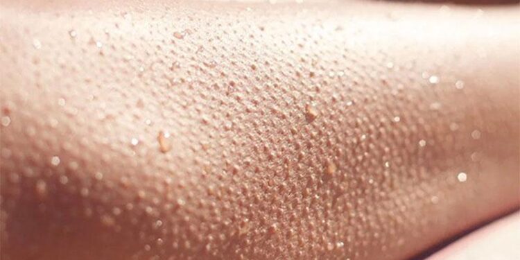 چرا بعد از لیزر ، پوست پیراشکی می شود! (20 علت + درمان ساده) 1 چرا بعد از لیزر ، پوست پیراشکی می شود 20