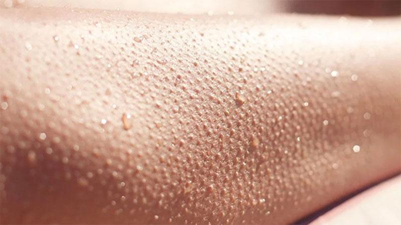 چرا بعد از لیزر ، پوست پیراشکی می شود! (20 علت + درمان ساده) 4 پس از لیزر پوست را اهدا کنید