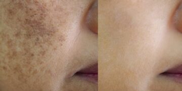 ضدلک چیست و چگونه لک‌های پوست را درمان می‌کند؟