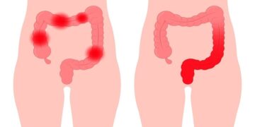 بیماری التهابی روده