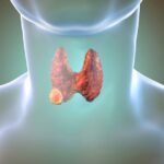 1756400843 925 علت تیروئید پرکار و روشهای درمانی آن