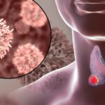 1756400844 185 علت تیروئید پرکار و روشهای درمانی آن