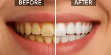 قبل و بعد از بلیچینگ دندان طبیعی با نتیجه فوری