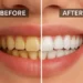 قبل و بعد از بلیچینگ دندان طبیعی با نتیجه فوری