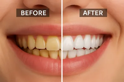 قبل و بعد از بلیچینگ دندان طبیعی با نتیجه فوری