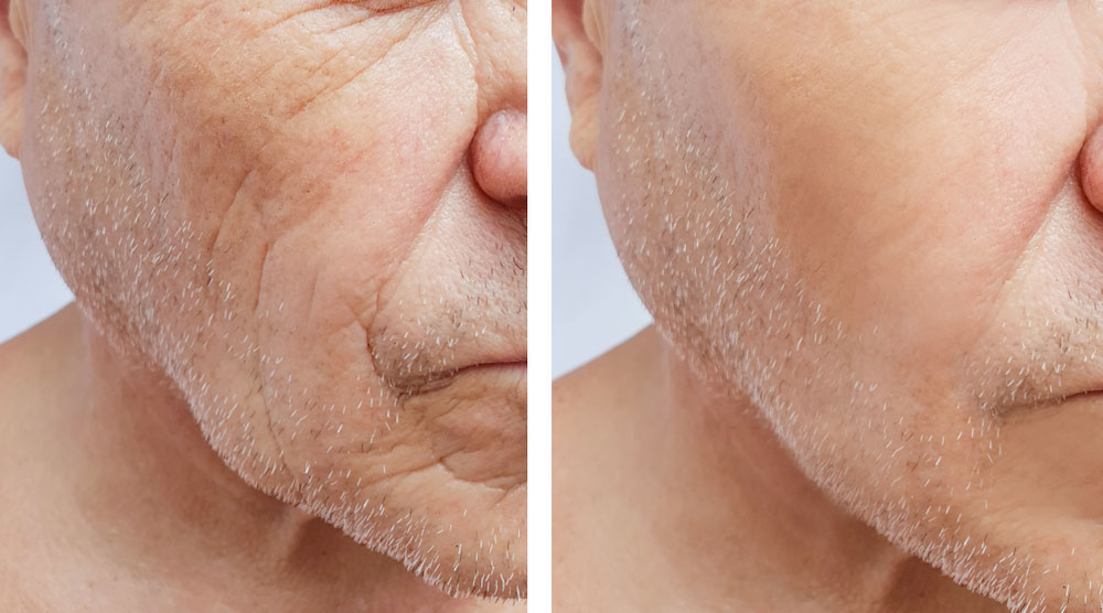 جوان سازی صورت