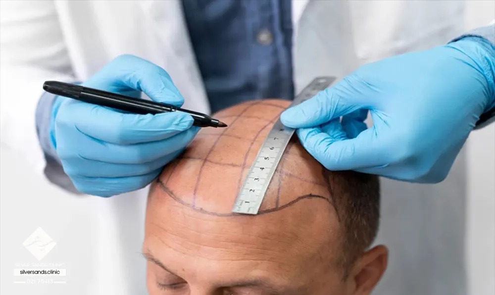 هزینه کاشت مو در سال 2 چقدر است؟ 7 روشهای مدرن SUT و DHI