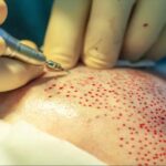 هزینه کاشت مو در سال 2 چقدر است؟ 4 1759850808 332 هزینه کاشت مو در سال 2 چقدر است؟