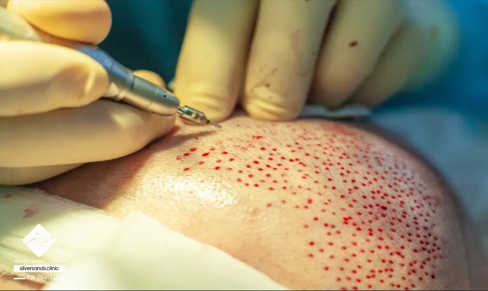 هزینه کاشت مو در سال 2 چقدر است؟ 8 مراقبت از قبل از پس از مراقبت