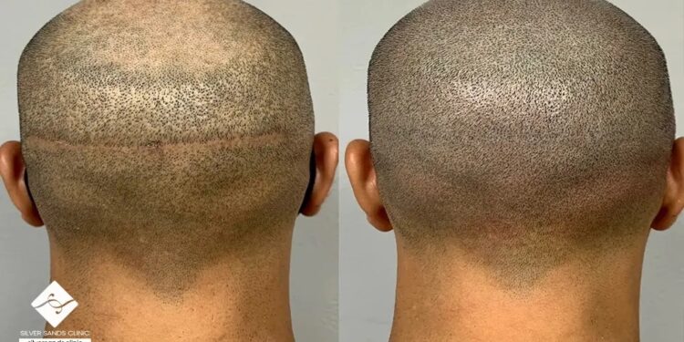 هزینه کاشت مو در سال 2 چقدر است؟ 1 هزینه کاشت مو در سال 2 چقدر است؟