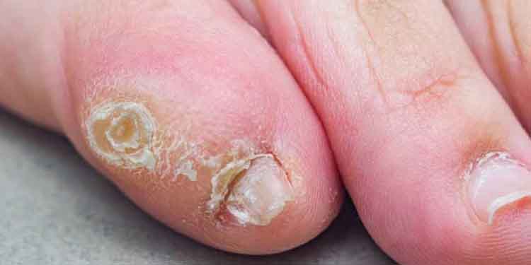 لیزر میخچه پا غرب تهران