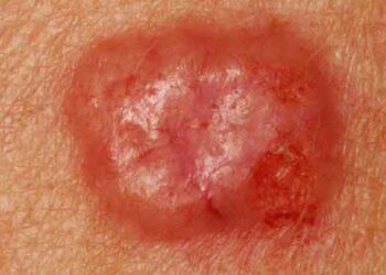 مجهزترین کلینیک درمان ضایعات پوستی در غرب تهران افتتاح شد 18 مجهزترین کلینیک درمان ضایعات پوستی در غرب تهران افتتاح شد