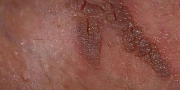 بهترین روش درمان زگیل تناسلی