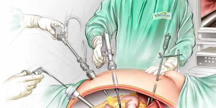 پروتکل دکتر محمد ایرانمنش برای جراحی اسلیو ایمن 3 ND9zrrKplAJ9b2oV82pQrJuP4MkfWJvzsYz7C0nr