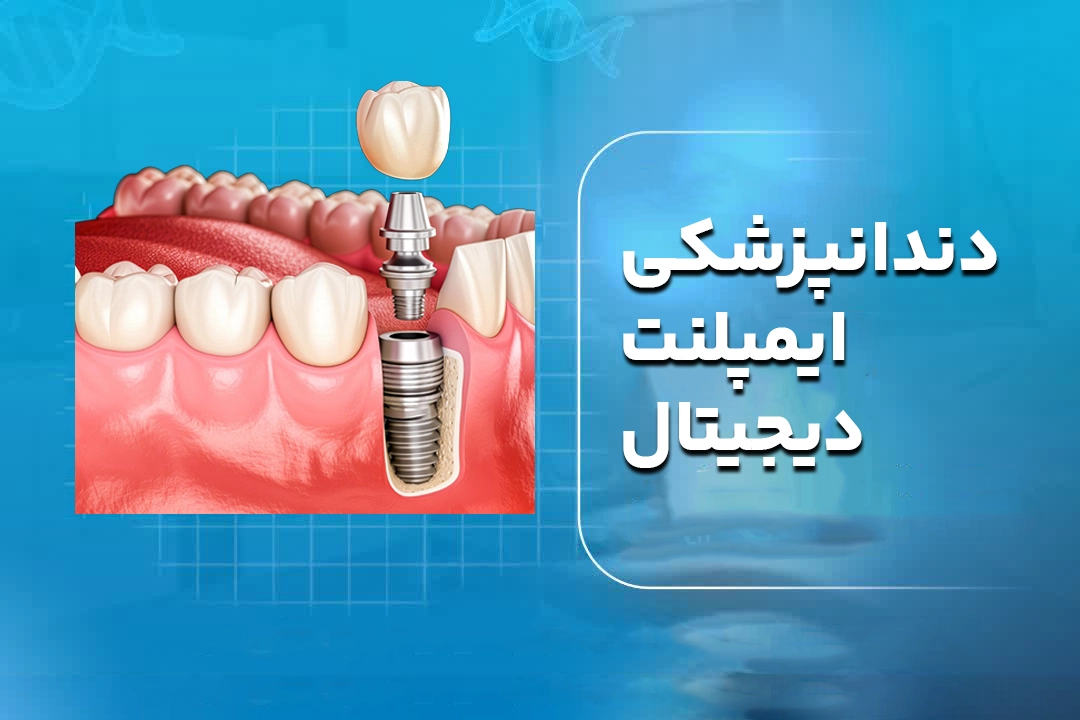 دندانپزشکی ایمپلنت دیجیتال