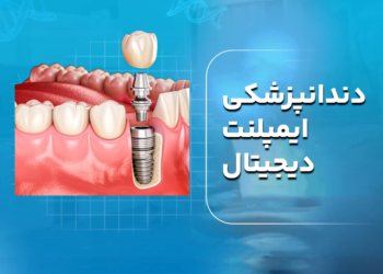 دندانپزشکی ایمپلنت دیجیتال