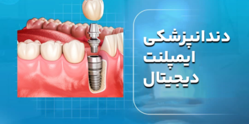 دندانپزشکی ایمپلنت دیجیتال