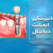 دندانپزشکی ایمپلنت دیجیتال