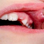 چه چیزی برای عفونت شدید دندان خوب است؟ درمان های خانگی سریع عفونت دندان 2 1788954258 723 چه چیزی برای عفونت شدید دندان خوب است؟ درمان های