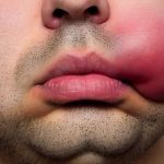چه چیزی برای عفونت شدید دندان خوب است؟ درمان های خانگی سریع عفونت دندان 4 1788954262 976 چه چیزی برای عفونت شدید دندان خوب است؟ درمان های