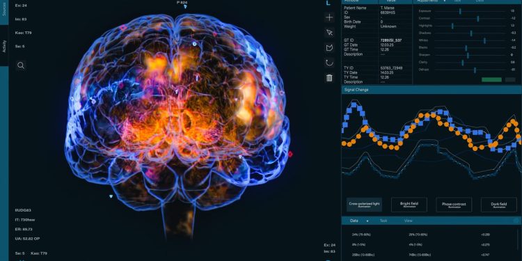 Colorful 3D brain rendering displayed in a medical data‑analysis interface with panels and charts on the right.